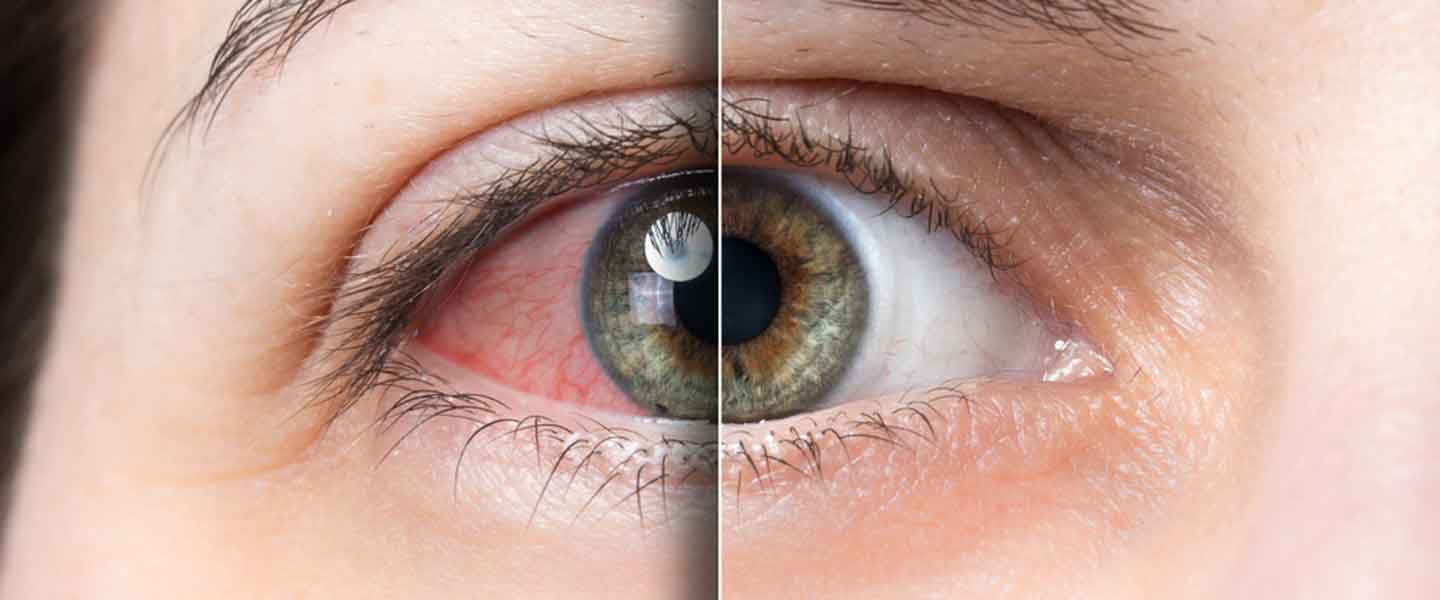 Göz kızarıklığına ne iyi gelir? Göz kızarıklığı nasıl geçer ve neden olur?